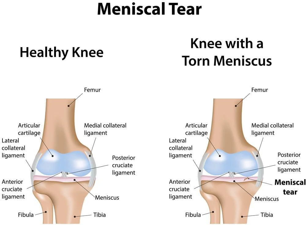 Knee Brace For Meniscus Tear After Surgery