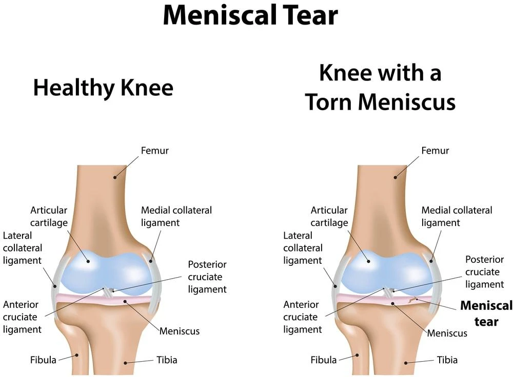 Torn Meniscus What is the Best Type of Knee Brace for a Torn Meniscus